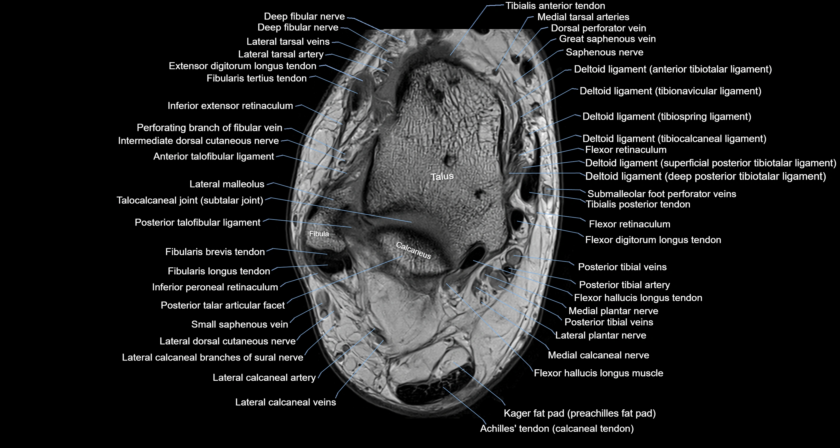 Ankle axial anatomy 3T MRI images -img-10001-00020.webp